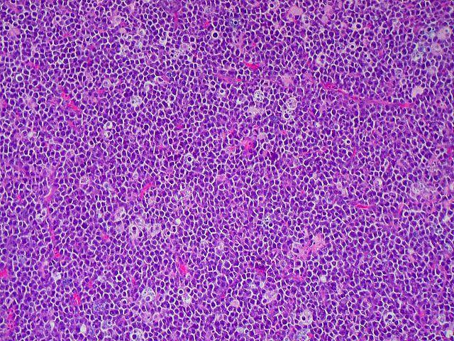 Köpenysejtes lymphoma Agresszív NHL Köpenysejt eredet (mantle zone) t(11;14) a bcl-1/cyclind1 gén az Ig-promoter mögé sejtproliferációt serkent Burkitt lymphoma