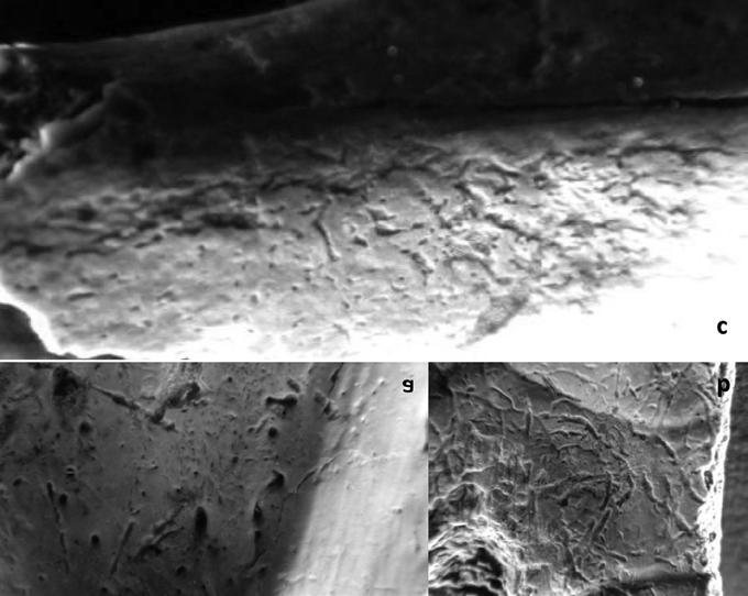 3. ábra: 6 7 éves gyermek csontmaradványain (ID 256) megfigyelhető endocranialis lézió (a b) és borda periostitis (c) nyomok. Fig.