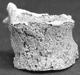 4. ágyékcsigolyán. A kismértékben hiányos 5. ágyéki csigolya testének felső felszíne porotikus, elülső oldalán kismértékű bemaródások, a test peremén osteophyta képződés figyelhető meg.