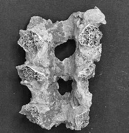 ábra: Az ágyéki csigolyaívek összecsontosodása. (a) Ventralis nézet, (b) dorsalis nézet (1078. sír).