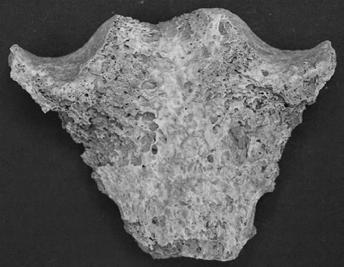 7. ábra: Gyulladás nyomai a manubrium sterni felszínén (1078. sír). Fig. 8: Traces of inflammation on the manubrium sterni (Grave No. 1078). Differenciáldiagnózis A Versend-Gilencsa lelőhely 1078.