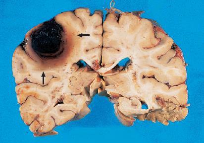 Thalamus 20% Pons