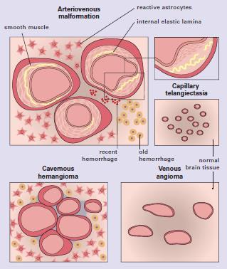 1I. Vascularis malformatio 1. Arteriovenous malformatio (AVM) 2.