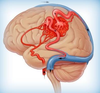 INTRACRANIALISVÉRZÉSEK Etiológia: I.