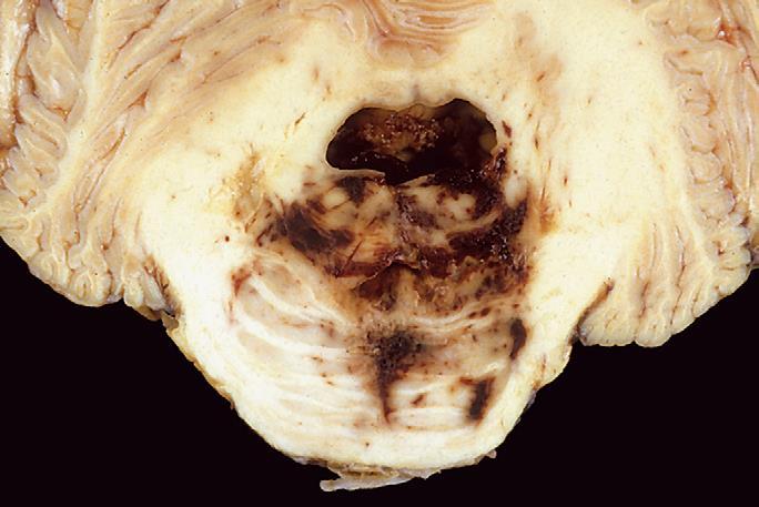 II. Transtentorialis herniatio Lobus temporalis herniatioja N. oculomotorius és a. cerebri post.