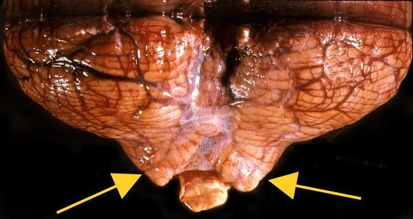 III. Tonsillaris herniatio Tonsillae cerebelli herniatioja Agytörzs kompressziója Nyúltvelő