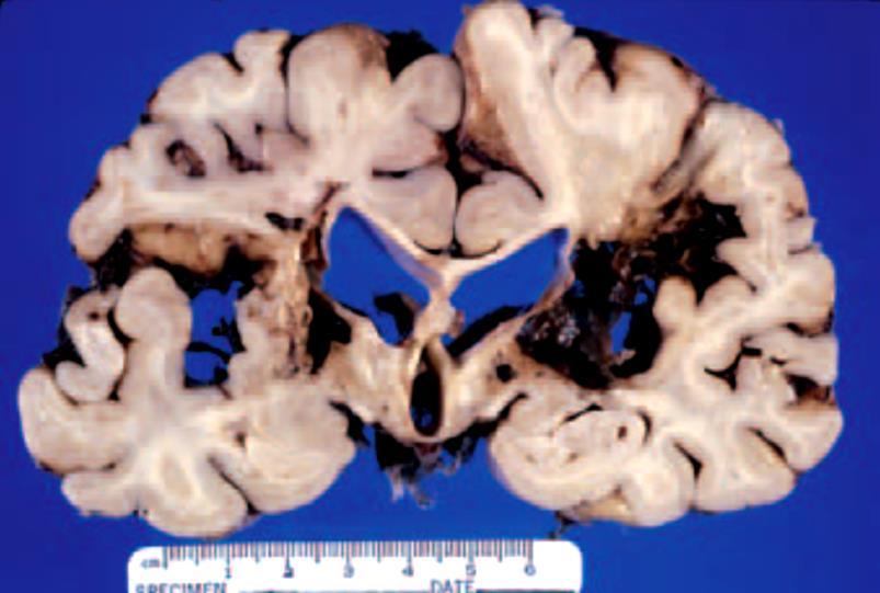 Intracerebralis vérzés morfológia Idő Macroscopia Microscopia Másodpercek Érfal ruptura Percek Élénk vörös hematoma Extravasatio Néhány óra Perifocalis oedema, térfoglalás, kompresszió Erythrocyta