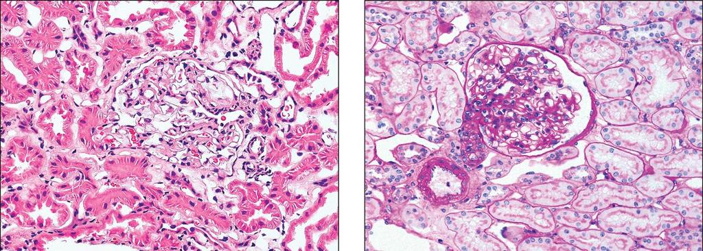 NORMÁLIS, HE festés NORMÁLIS, PAS festés GLOMERULOSCLEROSIS, PAS