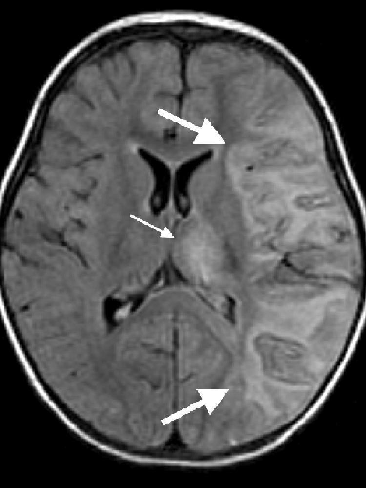 ENCEPHALITIS ELSŐ TEENDŐK ALAPTERÁPIA ALAPVIZSGÁLATOK UA MINT