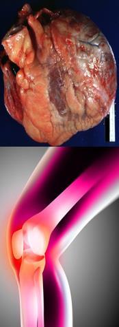 radiculitis Jellegzetes szindrómák: 1. Bell paresis (gyakran recidiv, vagy kétoldali) 2. Meningoradiculitis (Bannwart szindróma) 3.