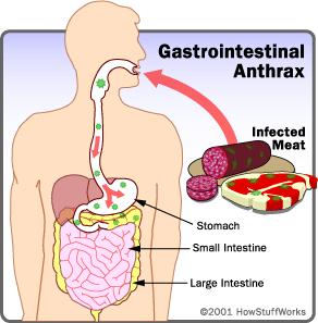 3. Gastrointestinális anthrax - Véres diarrhoea: Spóra GI traktusba kerül (nagyon ritka) Fekélyesedés