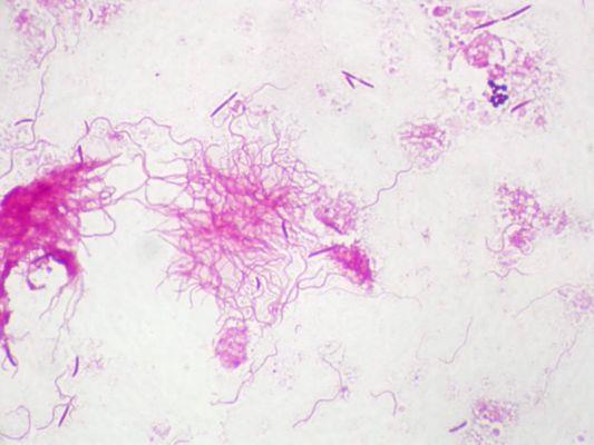 Plaut-Vincent angina Fusobacterium nucleatum + orális spirochaeta pl.