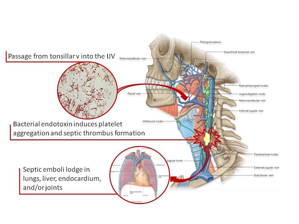Lemierre szindróma Akut oropharyngealis fertőzés => Mandula vénák trombózisa, Ráterjed a parapharyngeális térre => véna jugularis interna