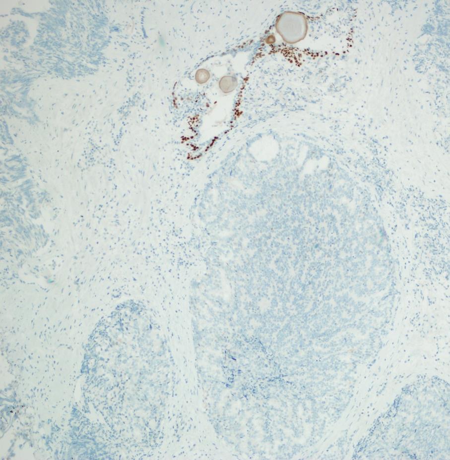Mikroszkópia Prostatacarcinoma megelőző állapota: PIN = prostata intraepithelialis neoplasia Prostata cc: torlódó, kis méretű, szűk lumenű mirigyek (strukturális atypia!