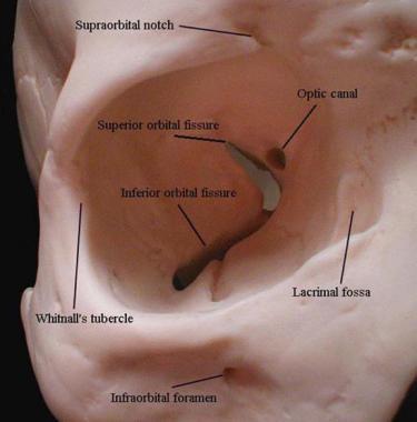 Maxilla: corpus maxillae sulcus infraorbitalis canalis