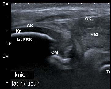 Simmental calf (4 weeks old) with a serofibrinous, septic polyarthritis of the left carpal, both tarsal and both