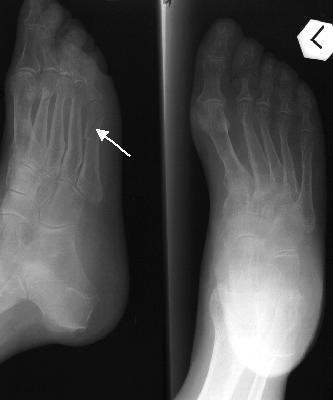 Kétirányú felvétel a bal lábfejrl bfejről: A csontok mésztartalma, m atrophia