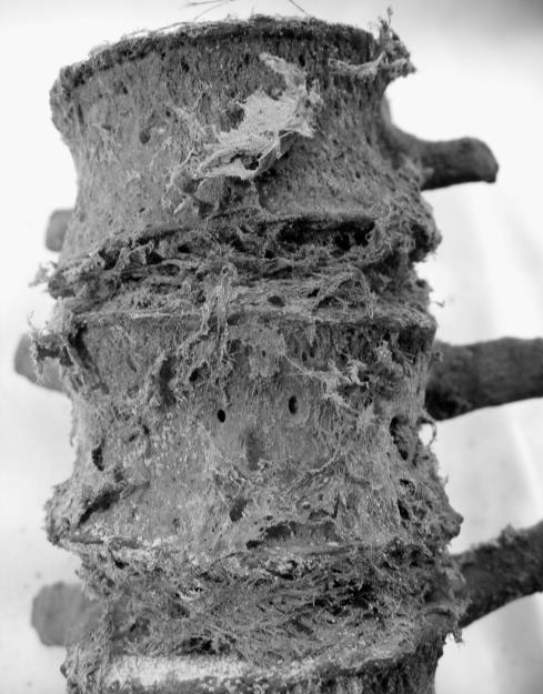 A szabadon álló csigolyákon kismértékű hypervascularisatio nyomai figyelhetők meg, amelyek felvethetik a tuberkulózis lehetőségét (Pálfi és mtsai 2012; 2. ábra).
