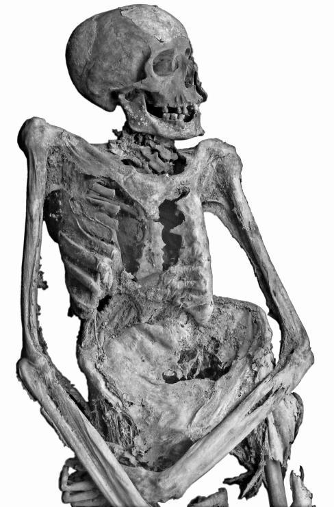 gerincen kisebb mértékű, a háti gerincen nagymértékű (60 foknál nagyobb) scoliosis figyelhető meg.
