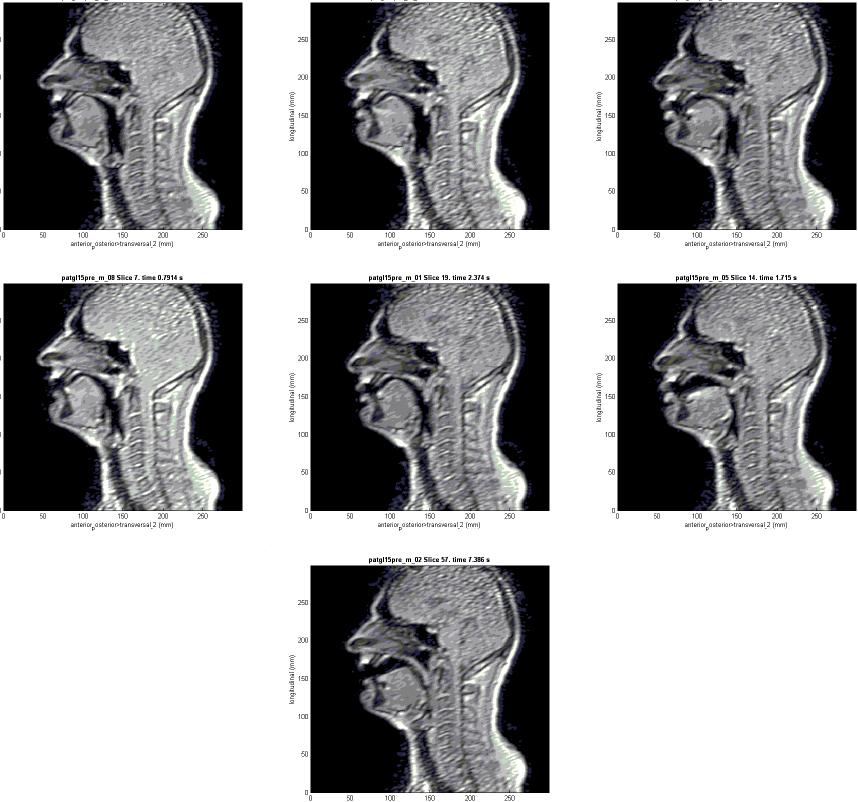 A magánhangzók képzése (MRI) i ü