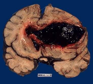 Thalamus