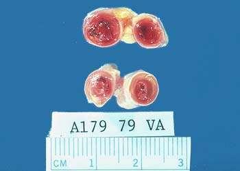 Venás thrombosis