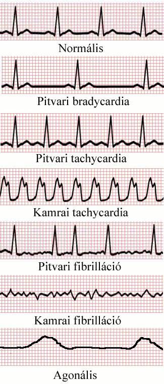 EKG Kóros EKG Bradycardia = kórosan alacsony szívfrekvencia Tachycardia =