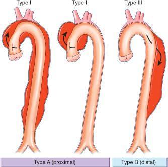 3. Aorta dissectio Felosztása: a., - Akut - Chronicus b.