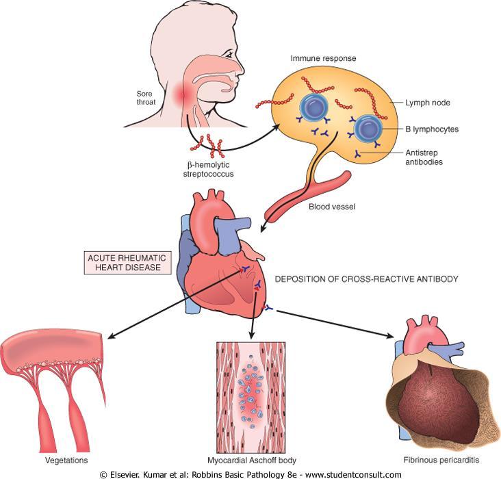 FIBRINOSUS Akut Rheumás Láz Pancarditis: fibrinous pericarditis, granulomatosus myocarditis, endocarditis Etiologia: akut, immunologiai