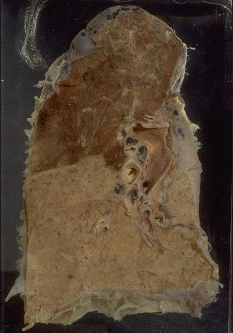 FIBRINOSUS/FIBRINOSO-PURULENS Lobaris pneumonia Morphology (Stages) 1. Congestio 2. 2. 3. nap: Hepatisatio rubra 3. 4.