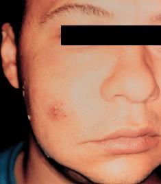 PURULENT Purulens bőrgyulladások (pyoderma)