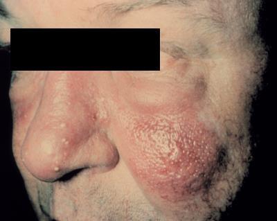 (Folliculus+dermis) Carbunculus (több egymás