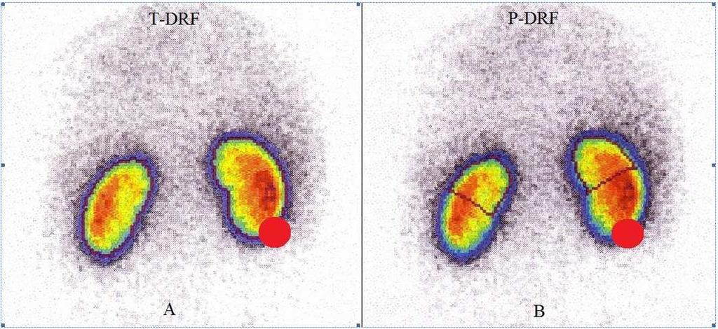 Any postoperative decline in the P-DRF of the operated kidney was considered as the renal functional loss resulted from IR injury only.