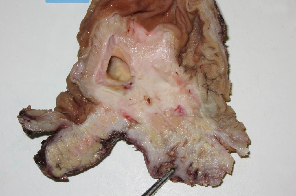 Pancreatitis chronica pseudocystával Kép