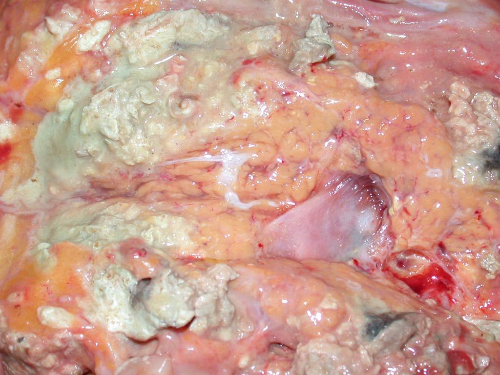 Acut pancreatitis Kép a SE II.