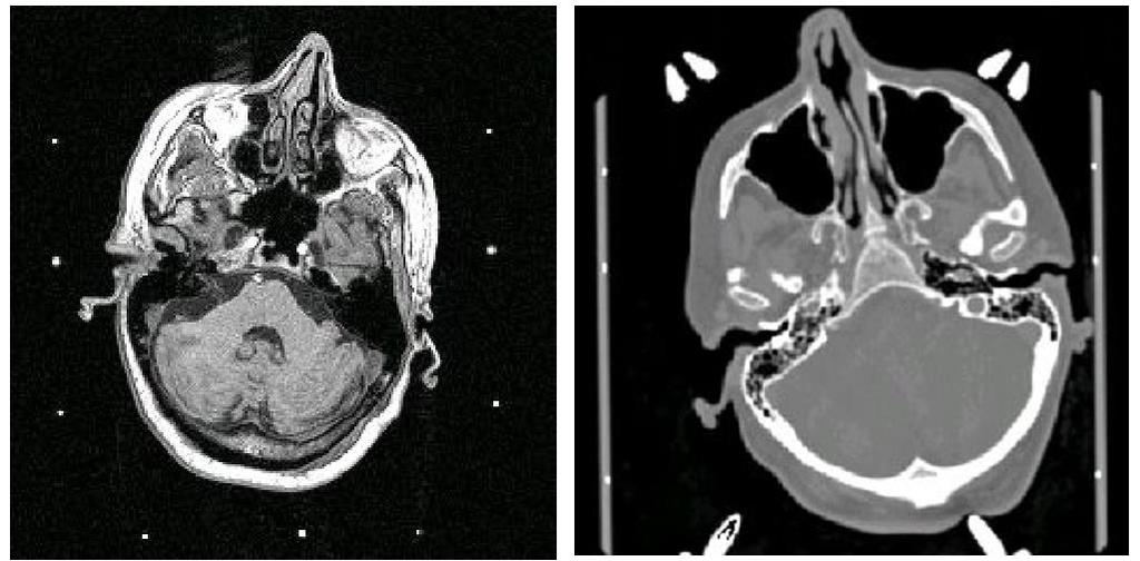 Fúzióra: MRI-CT, PET-CT Regisztráció célja CT csontok,