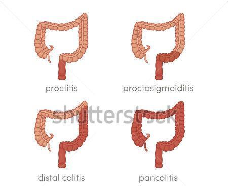 Lokalizáció Kolitisz ulceróza lokalizáció E1 proctitis E2 bal oldali (flexura lienalistól dist.