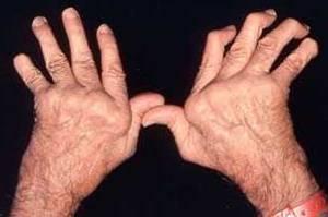 Rheumatoid