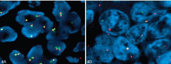 ALK-translocation Wild type ALK Translocated ALK-signal