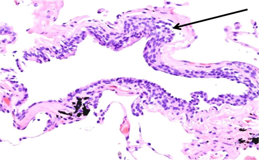 Figure 5. Neuroendocrine cell hyperplasia (arrow) within terminal bronchiole submucosal layer. Am J Respir Crit Care Med, http://www.atsjournals.org/doi/abs/10.1164/rccm.