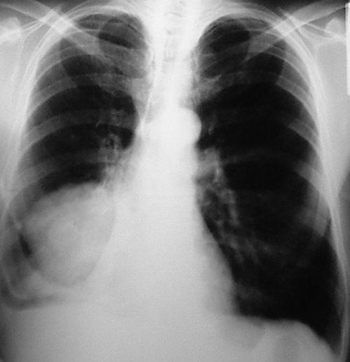 A tüdőrák tünetei - mik a legáltalánosabb panaszok?