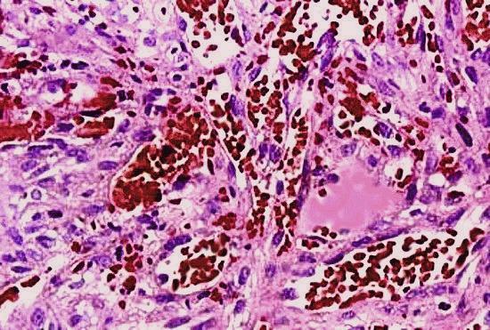 Főbb szövettani típusaik: Leiomyosarcoma Angiosarcoma Liposarcoma