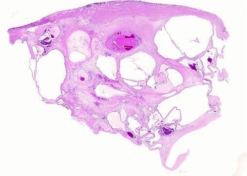 multilocular cystic renal