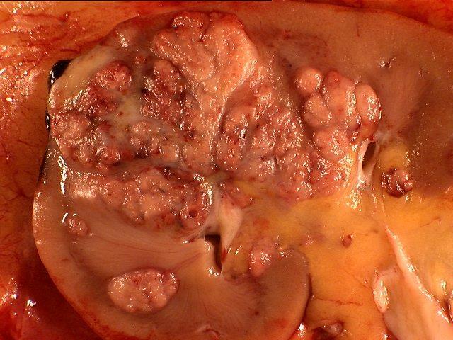 Carcinoma