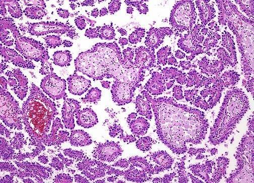Carcinoma