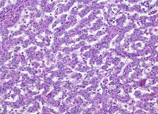 Carcinoma