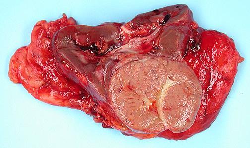 Carcinoma