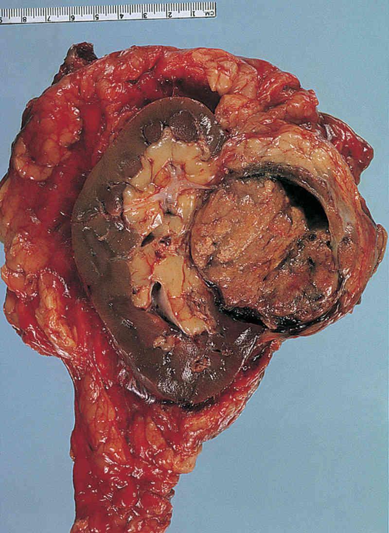 Carcinoma