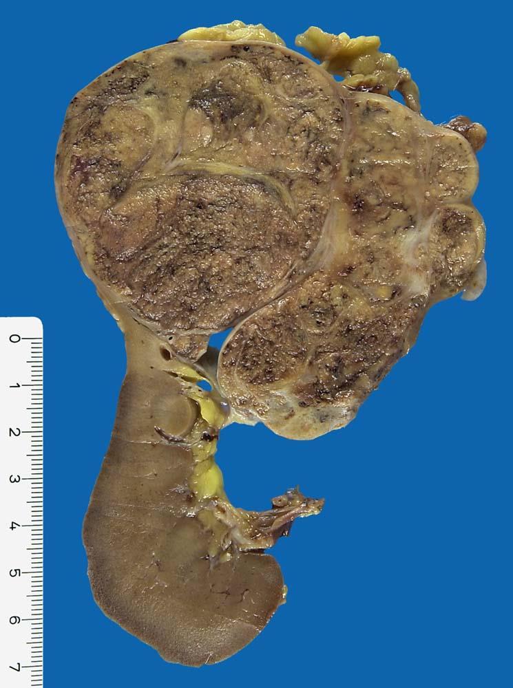 Carcinoma