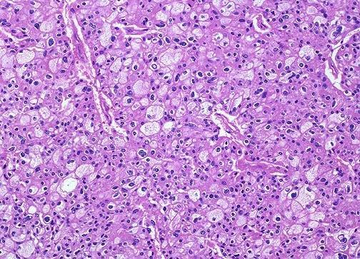 Carcinoma